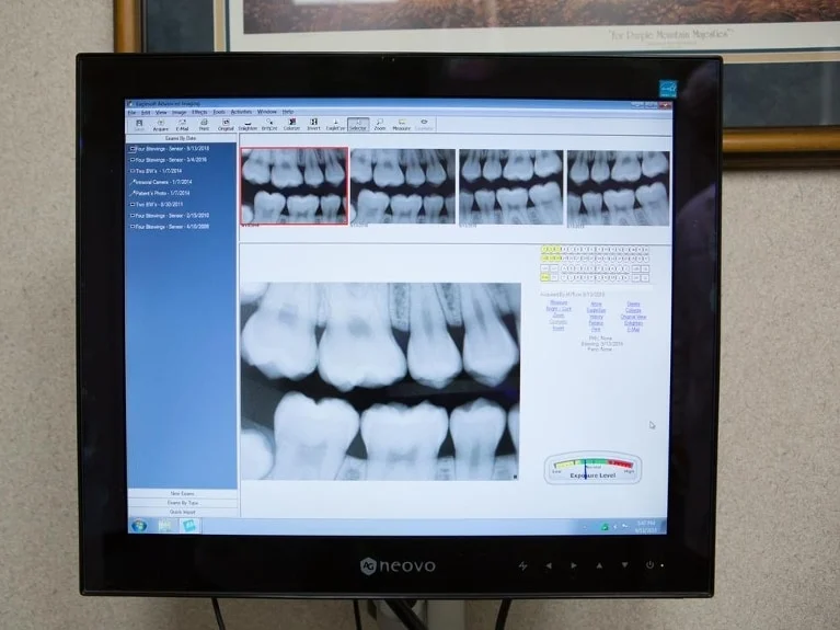 Digital-Dental-X-Rays