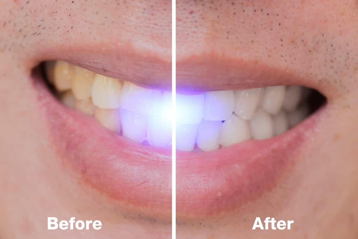 Dental Laser Comparison