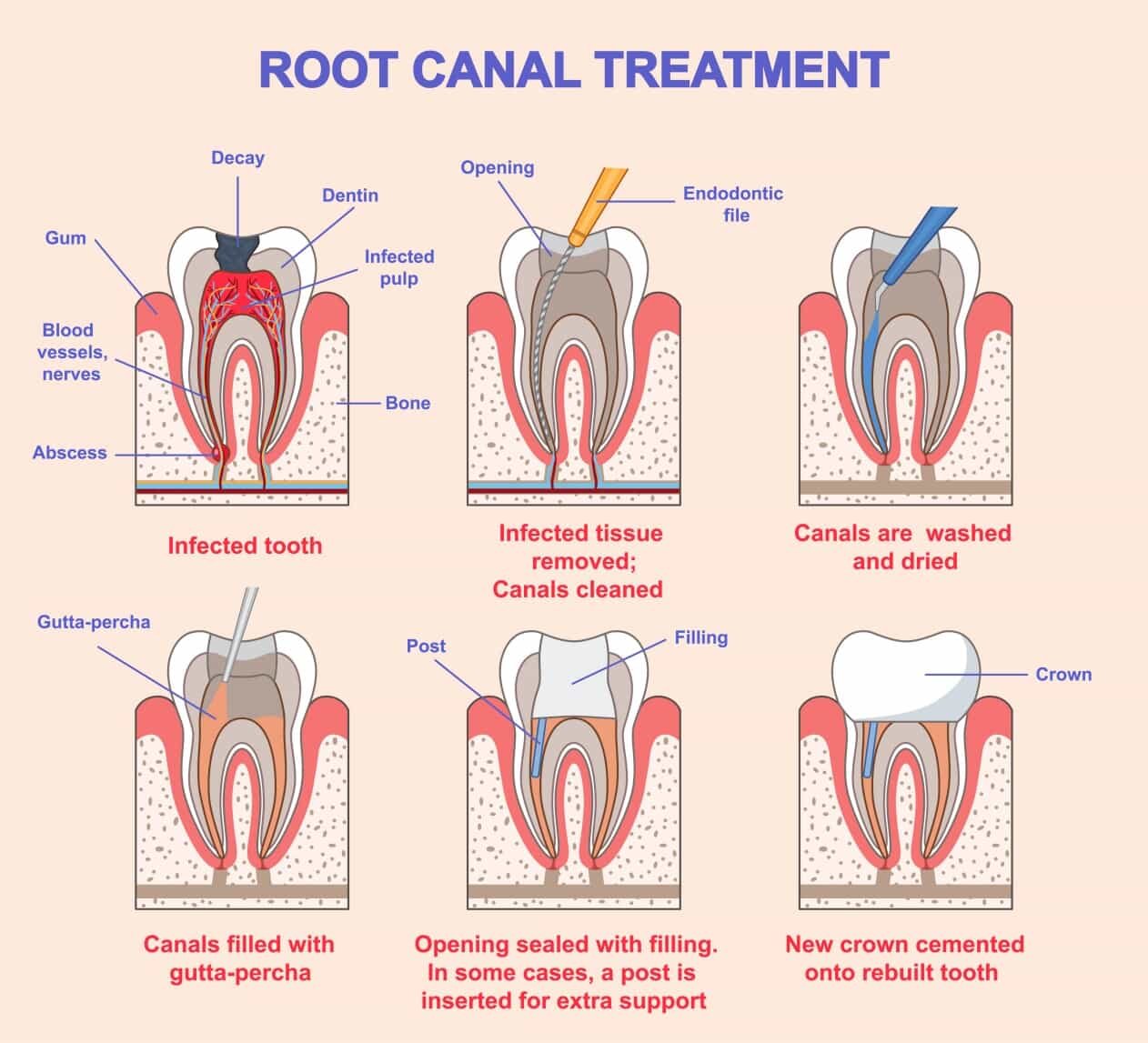 Root Canals